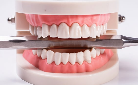 Dental Implants